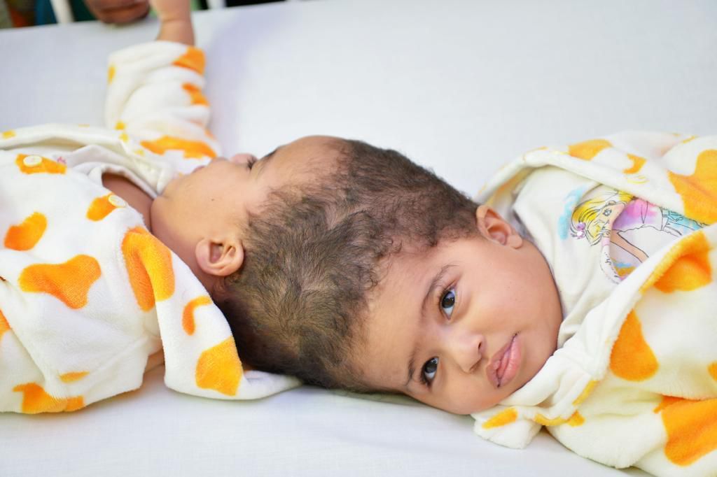 نجاح عملية فصل التوأم الملتصق الإريتري "أسماء وسمية" بعد عملية جراحية دقيقة استغرقت 15 ساعة ونصفًا